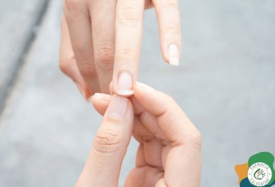 Mano con unghia spezzata che mostra i segni di fragilità tipici dopo l’estate.