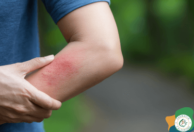 Persona che mostra un’eruzione rossa sul gomito, probabile reazione dovuta dalla puntura di un insetto.